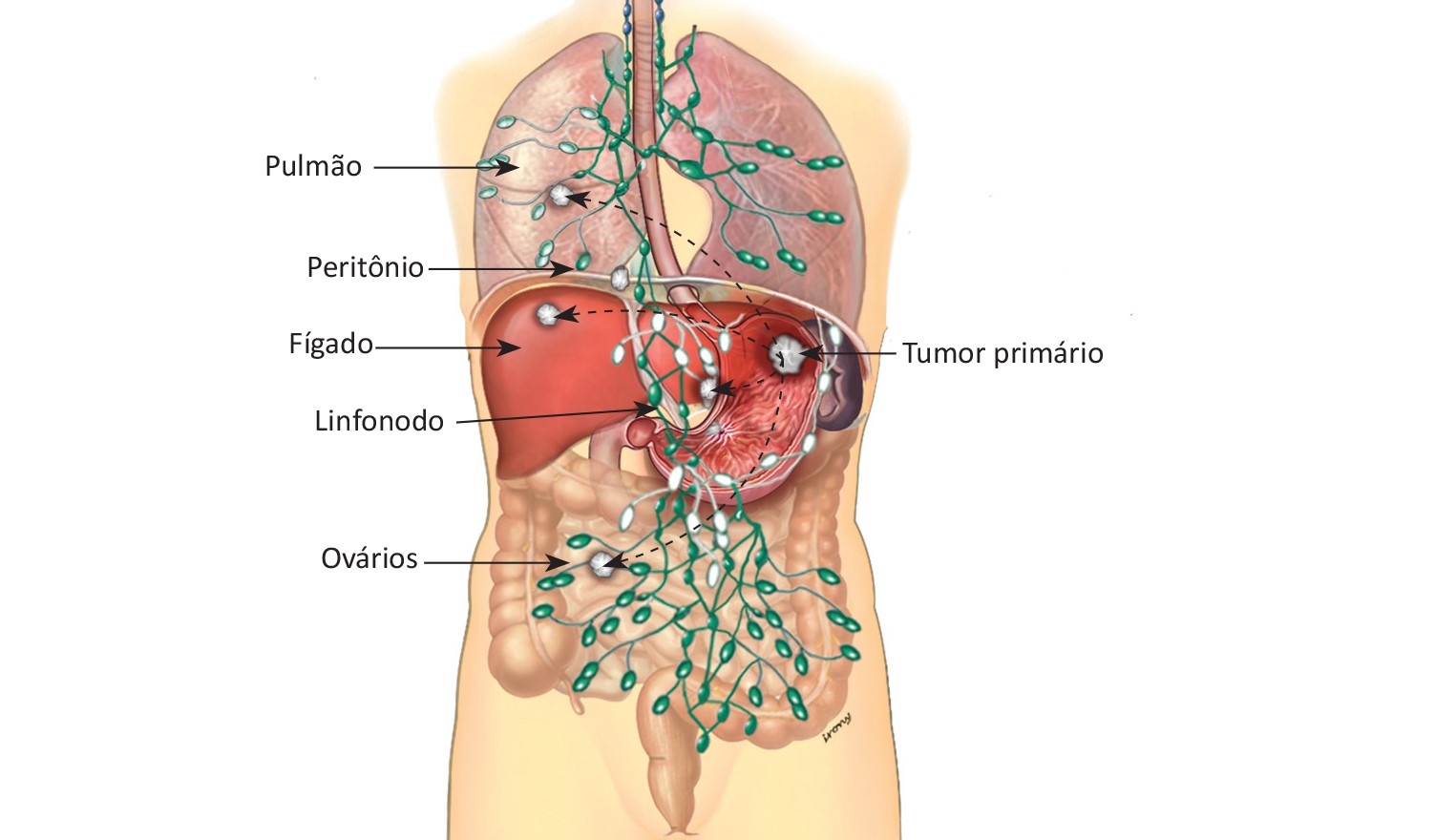cancer no peritonio