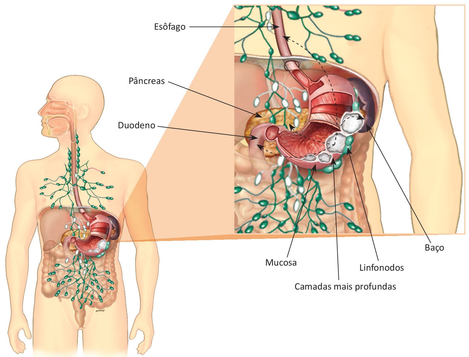 cancer gastrico peritoneal)